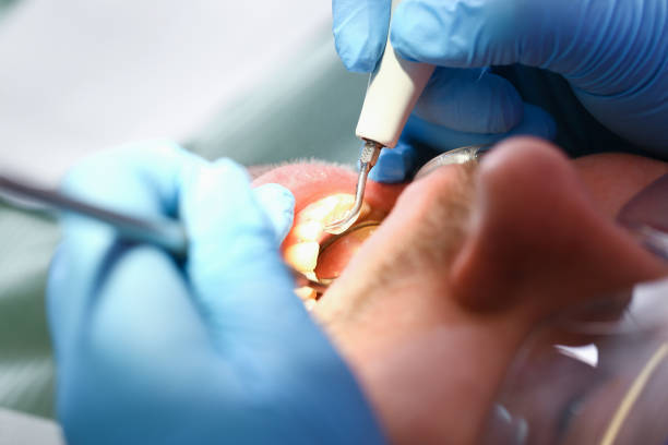 Best Emergency Root Canal Treatment in Moodus, CT